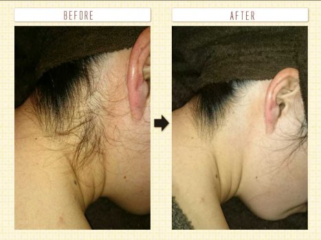 うなじの脱毛も意外と皆こっそりやってます！