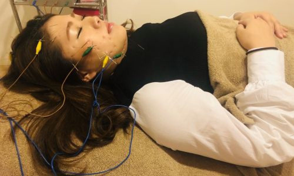 今☆話題の美容鍼！50本の鍼に電気を流していきます。