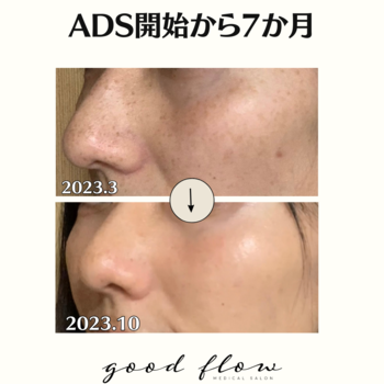 ADS肌改善プログラム開始7ヶ月