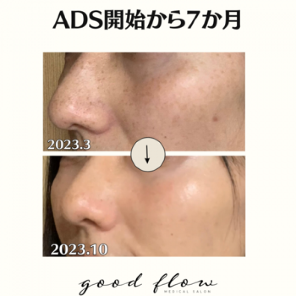 ADS肌改善プログラム開始7ヶ月