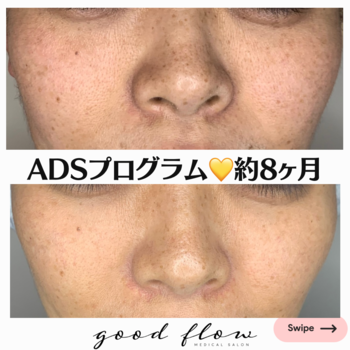ADS美肌プログラム８ヶ月